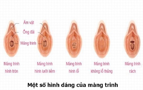 Hình dạng của màng trinh