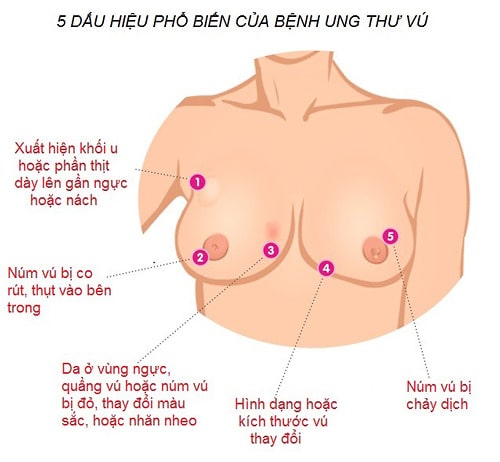 Dấu hiệu ung thư vú