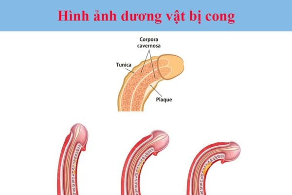 Có rất nhiều các nguyên nhân khiến dương vật bị cong