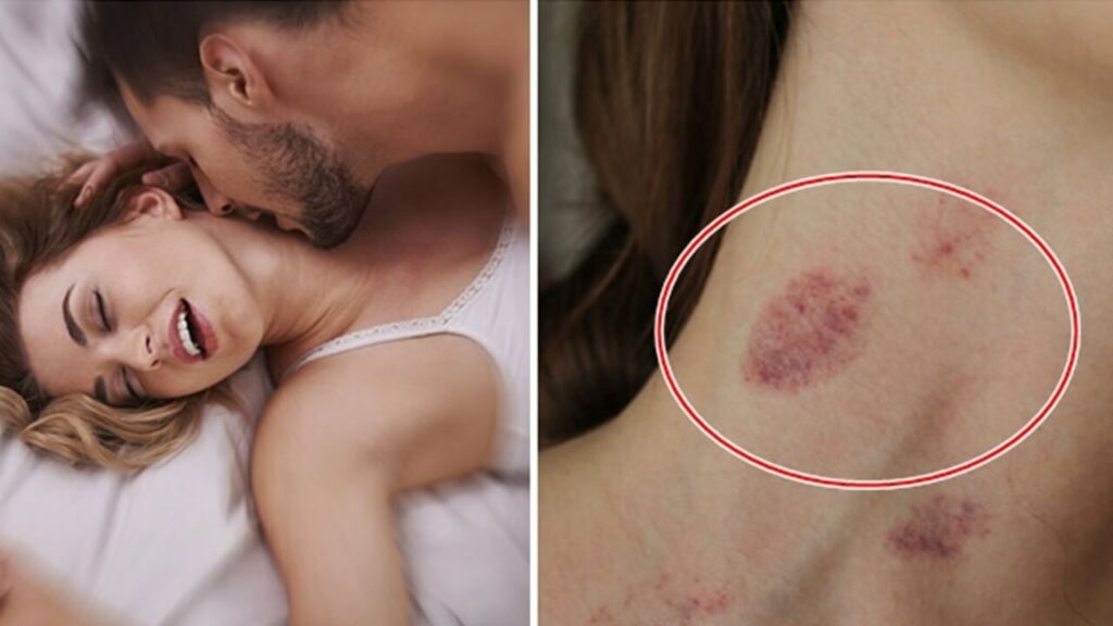  Hôn Hickey Là Gì? Hình ảnh hôn hickey