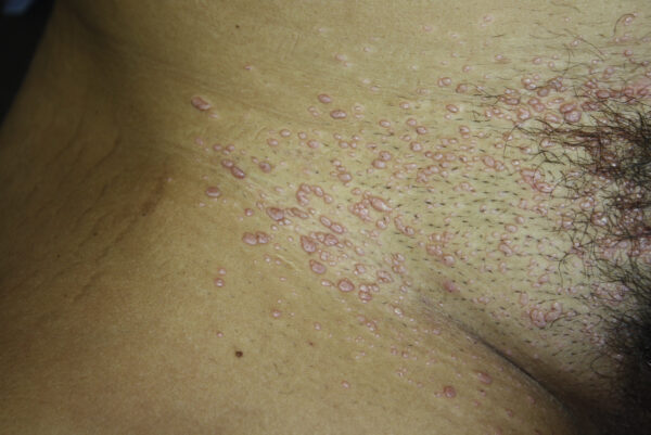 Bệnh do molluscum contagiosum