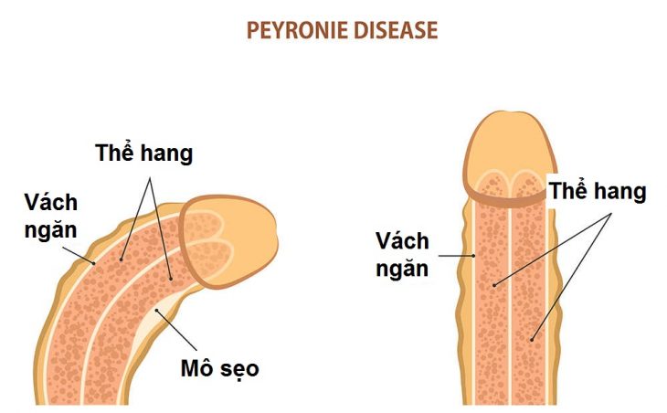 Dương vật bị cong làm thế nào để thẳng