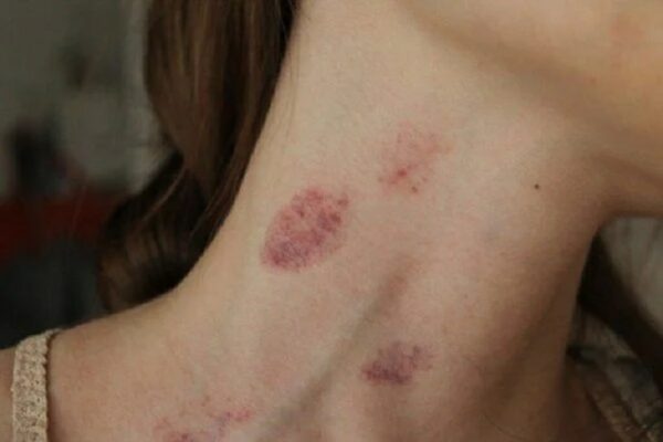 hickey