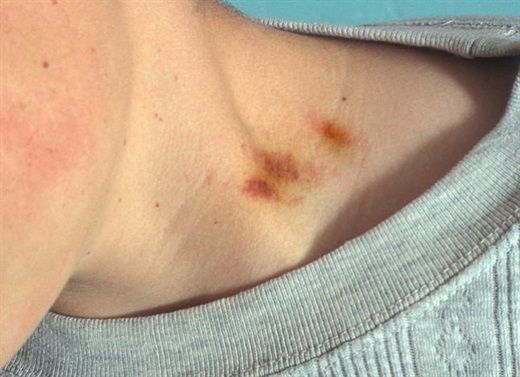 hickey ở cổ