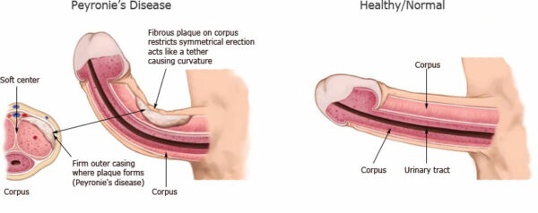 Có rất nhiều các nguyên nhân khiến dương vật bị cong