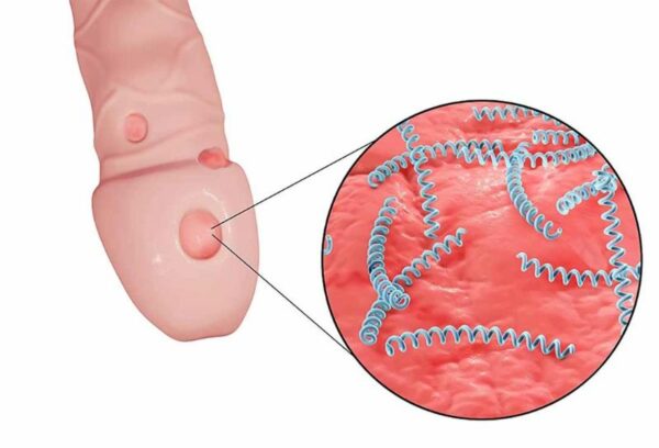 Nổi mụn ở đầu dương vật do bệnh giang mai
