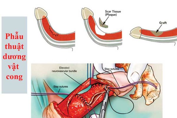 Phẫu thuật dương vật cong