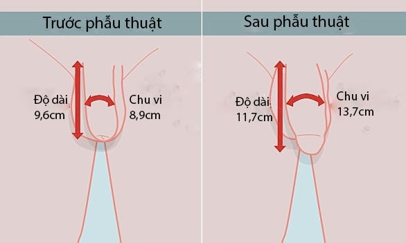 Phẫu thuật thay đổi kích thước dương vật